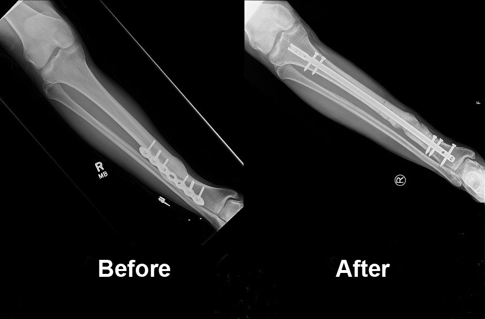 Malunion before and after